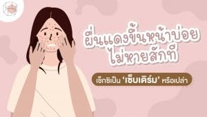 เซ็บเดิร์ม (sebderm)